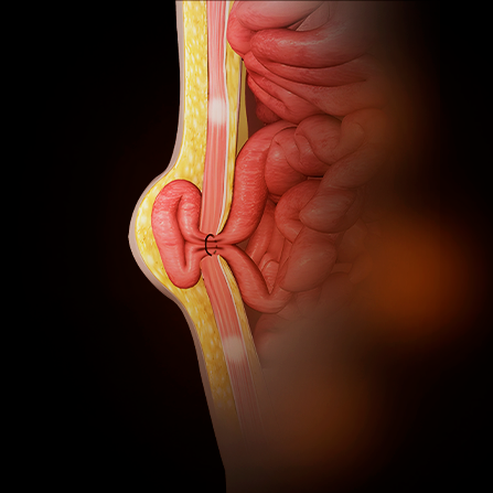 Hernia Repair
